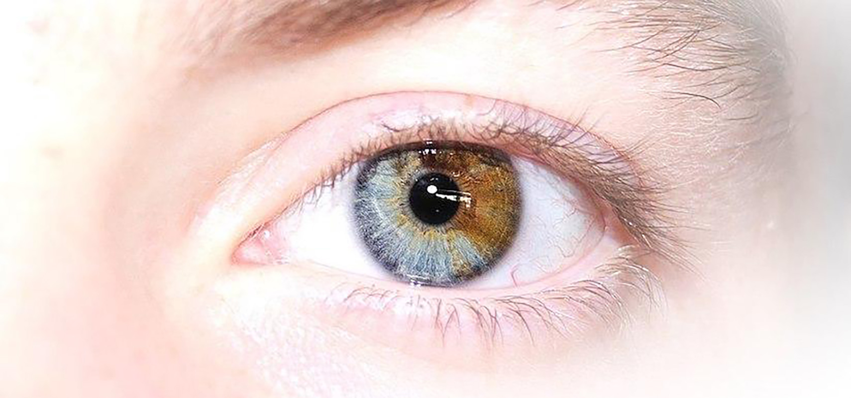 Sectoral heterochromia.